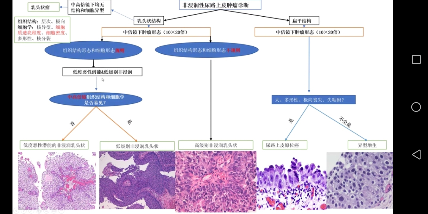 非浸润性尿路上皮肿瘤听课笔记（八十四）