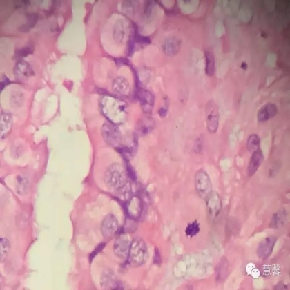 子宫腺肉瘤【吴梅娟】分享；【刘从容】老师讲解）