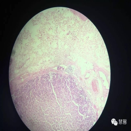 胃癌化疗后黏膜无癌、黏膜下广泛癌栓（慧馨分享，孔祥田(Max)*Roswell）