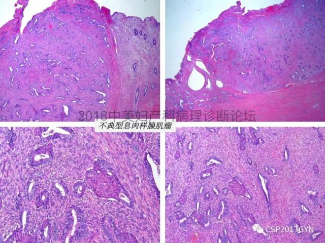 子宫内膜假肿瘤性病变及类似癌样病变
