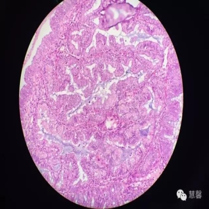 高分化子宫内膜样癌与分泌期子宫内膜、黏液腺癌的鉴别（孔令英分享，刘从容老师讲解）