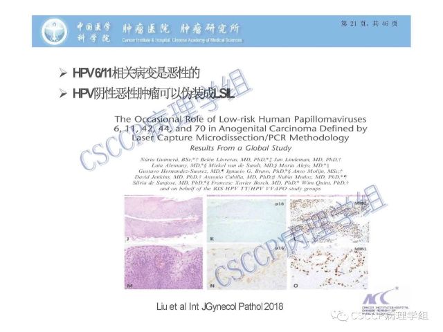 宫颈癌前病变中的诊断难点及阴道镜中ECC的 应用价值