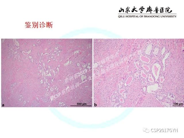中华病理学会基层培训遵义站讲座（四）——宫颈腺癌的诊断及新分型