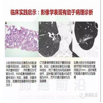 肺癌新分期和分类--临床和研究启示