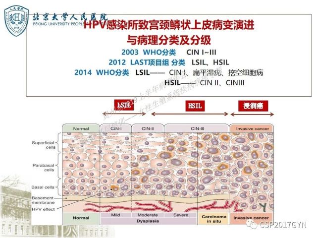 中华病理学会基层培训遵义站讲座（三）——宫颈鳞状上皮病变的病理诊断与鉴别诊断