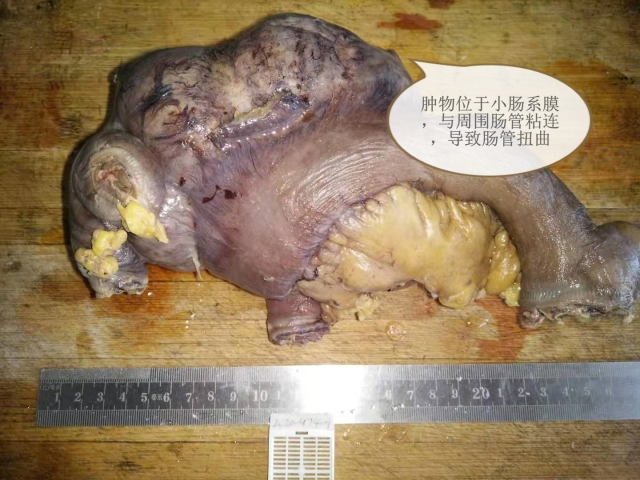 外伤引发间质瘤出血——病理科工作札记（五十五）