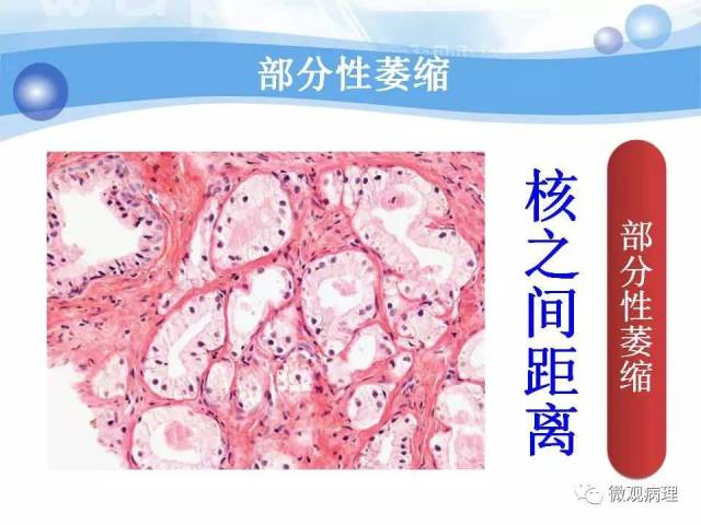 泌尿课程/局灶性前列腺萎缩