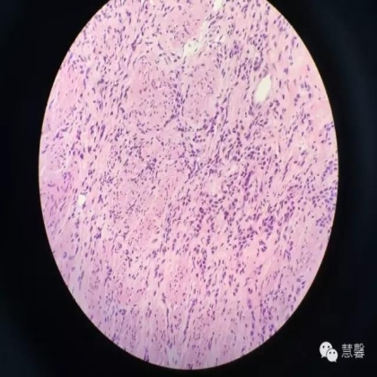 High grade nested variant Urothelial carcinoma(老胡分享，孔祥田老师讲解)
