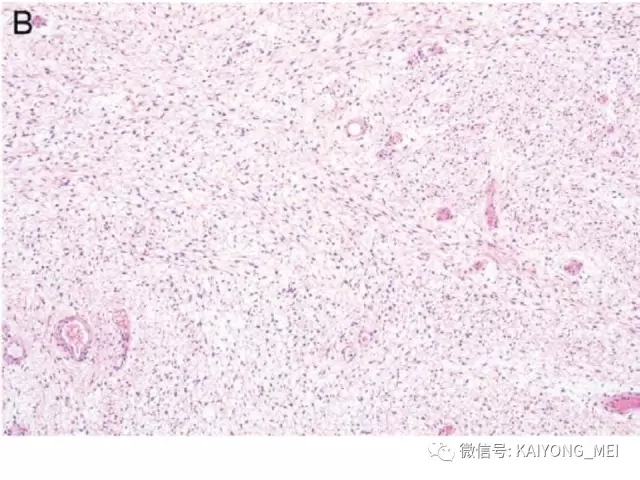 女性生殖道软组织肿瘤病理诊断及进展（一）
