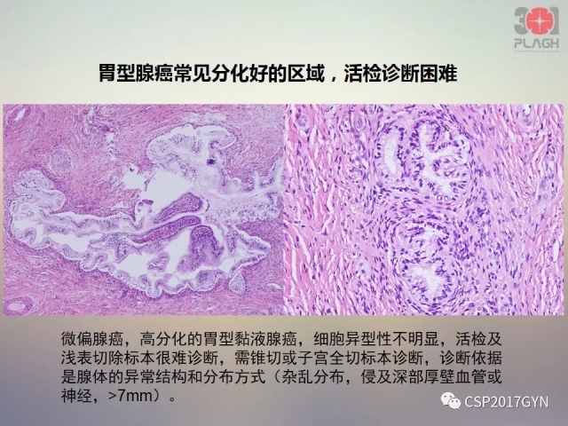 宫颈腺癌的临床病理研究进展