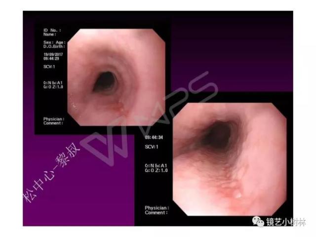 上消化道早癌病理的学习心得体会（附胃牵手癌的病例特点文献学习）