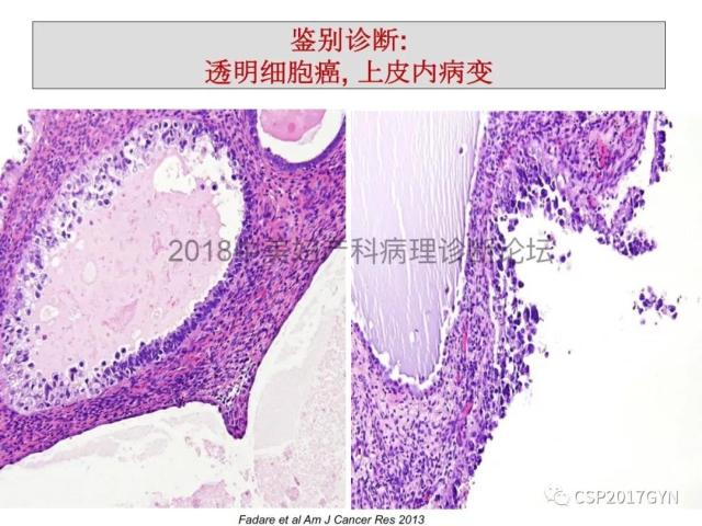 子宫内膜假肿瘤性病变及类似癌样病变