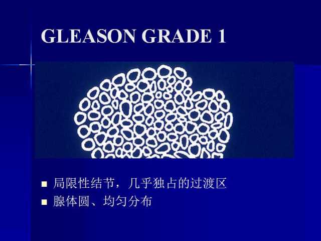 前列腺病理诊断线索（下）——黄教悌