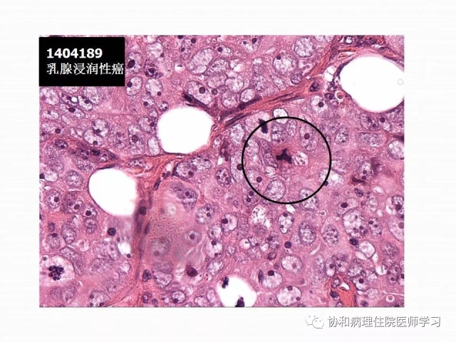 病理学基础知识 : 核分裂像的识别