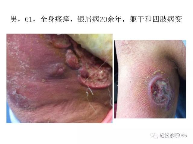 皮肤T细胞淋巴瘤