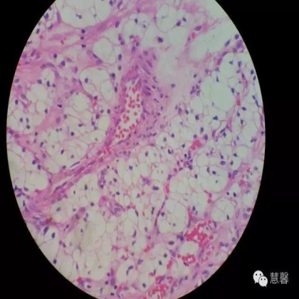 透明细胞乳头状肾细胞癌？TFE3 Traslocation Carcinoma？（赵洋分享，孔祥田(Max)*NM老师讲解）