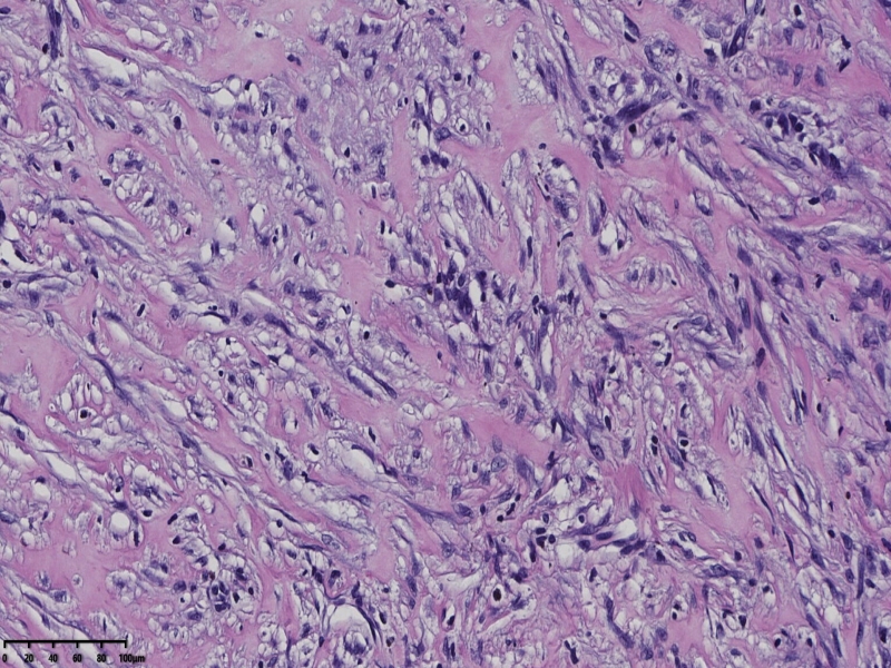 睾丸鞘膜肿物伴鞘膜积液