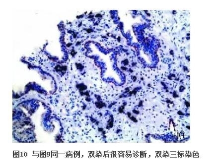 前列腺疾病的免疫组化诊断