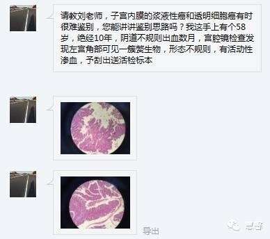 子宫内膜浆液性癌与透明细胞癌的区别（刘从容老师讲解）