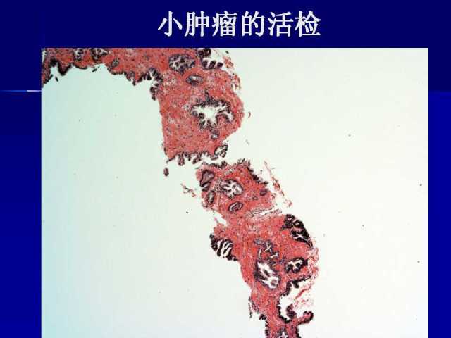 前列腺病理诊断线索（下）——黄教悌