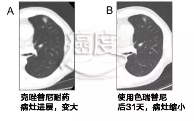 最新报道：ALK和ROS1突变肺癌的复杂耐药机制