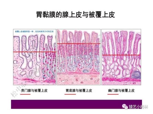 上消化道早癌病理的学习心得体会（附胃牵手癌的病例特点文献学习）