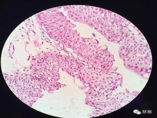 尿路上皮乳头状瘤、低级别尿路上皮乳头状癌的诊断及鉴别诊断，再听孔祥田(Max)*Roswell*NM老师讲解