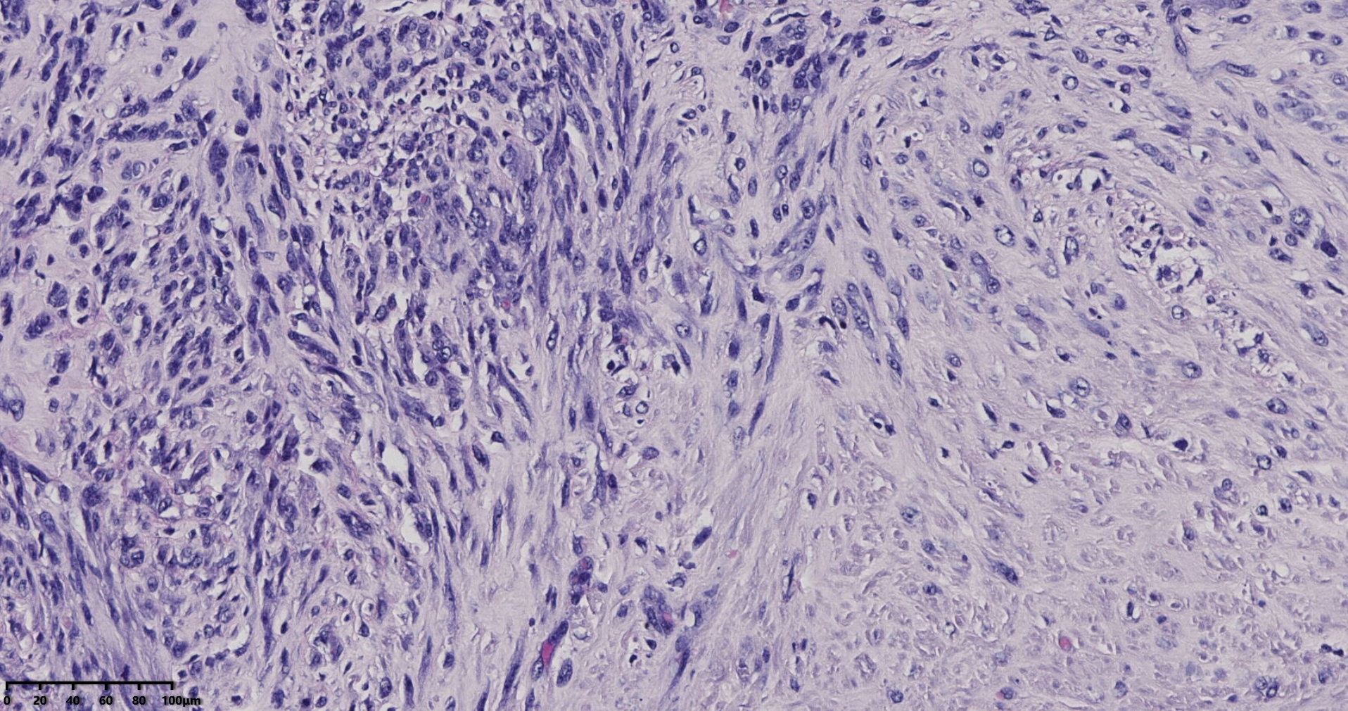 子宫多发性平滑肌瘤伴肉瘤