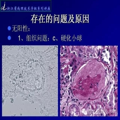探讨免疫组织学在肾穿标本中的应用