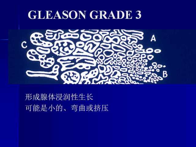 前列腺病理诊断线索（下）——黄教悌