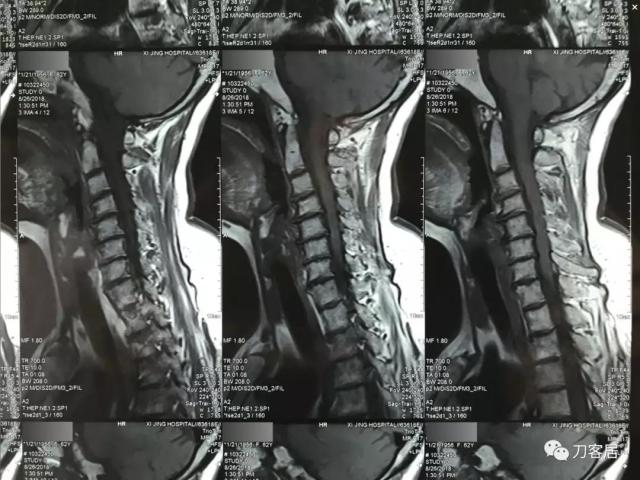 医生及患者通用:如何用手机翻拍X线片,磁共振片子,CT片子进行网络求医、病例讨论及保留资料 医生及患者通用:如何用手机翻拍X线片,磁共振片子,CT片子进行网络求医、病例讨论及保留资料