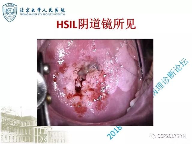 宫颈鳞状上皮内病变病理诊断中问题