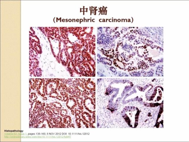非HPV感染相关性宫颈腺性病变