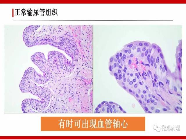 泌尿课程/非浸润性尿路上皮病变诊断的一些困惑