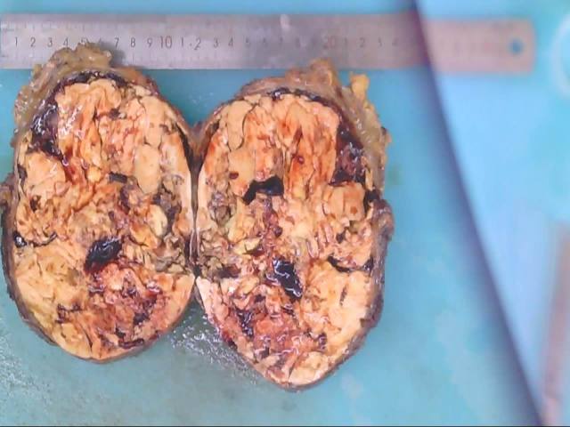 腹膜后脂肪肉瘤