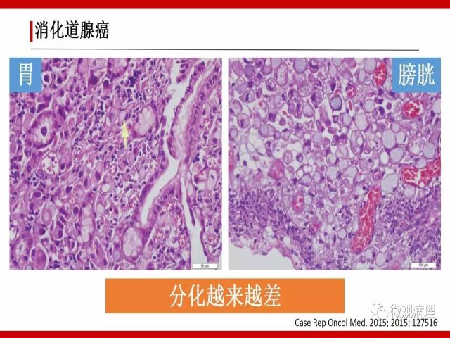 泌尿课程/尿路腺样病变的诊断要点