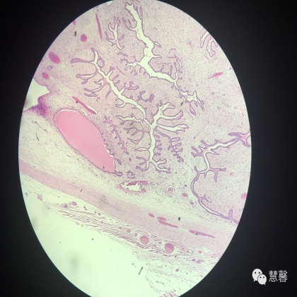 乳腺叶状肿瘤诊断（慧馨分享，孔祥田(Max)*Roswell*NM老师讲解）