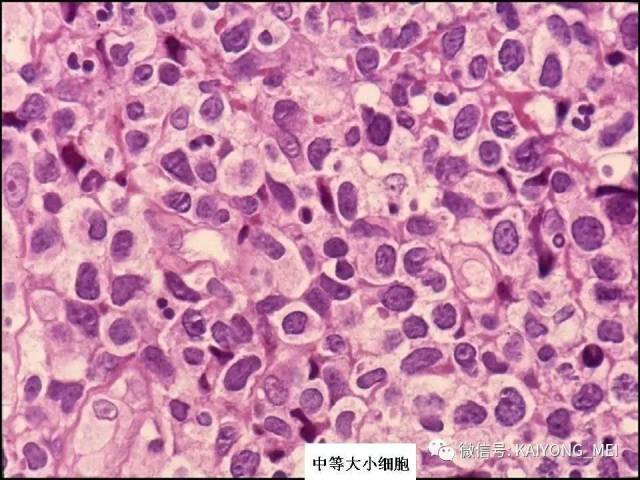 T细胞淋巴瘤病理诊断及进展（三）