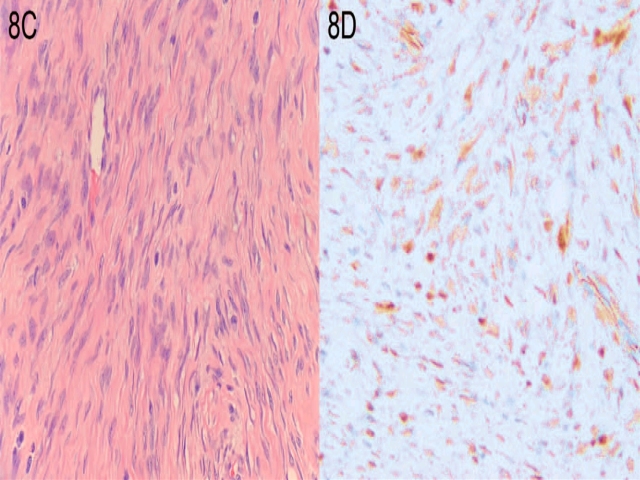 家族性腺瘤性息肉病综合征之庖丁解牛（四）