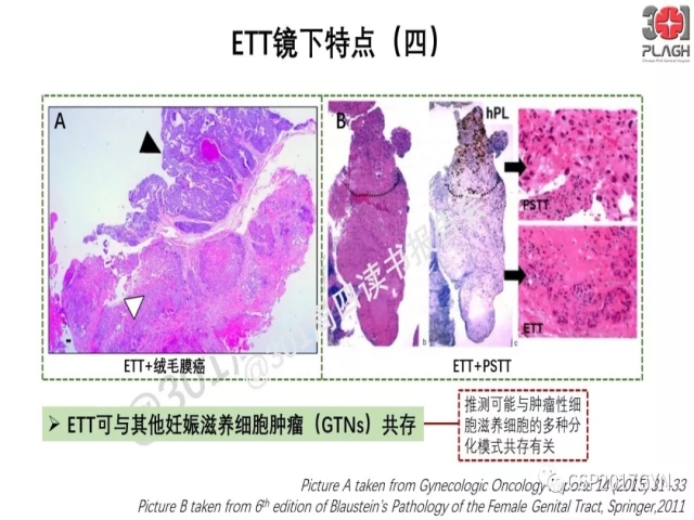 中间型滋养细胞肿瘤的诊断及鉴别诊断