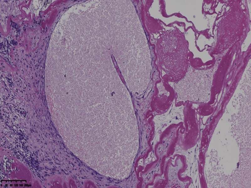 睾丸鞘膜肿物伴鞘膜积液