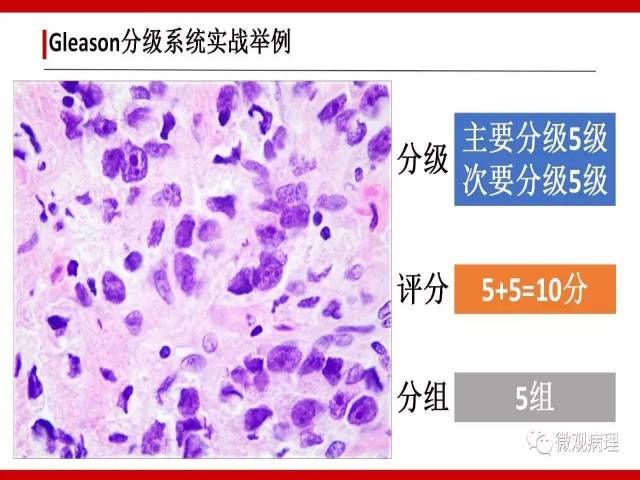 前列腺癌Gleason分级系统的前世今生