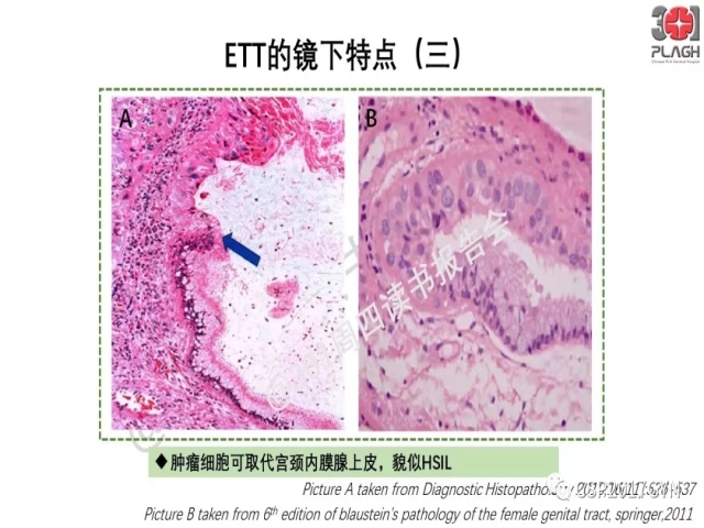 中间型滋养细胞肿瘤的诊断及鉴别诊断