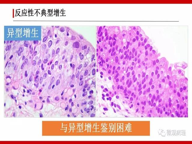 泌尿课程/非浸润性尿路上皮病变诊断的一些困惑