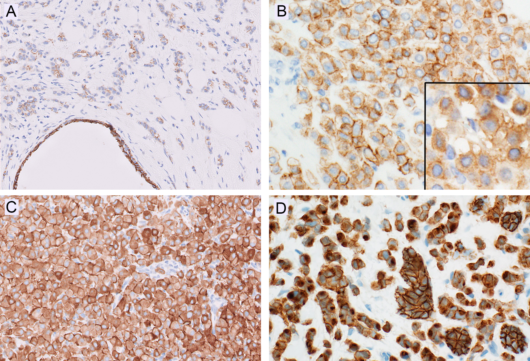 分子时代的乳腺小叶性病变再学习（三）