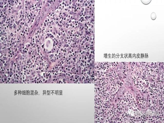 血管免疫母T细胞淋巴瘤的病理诊断