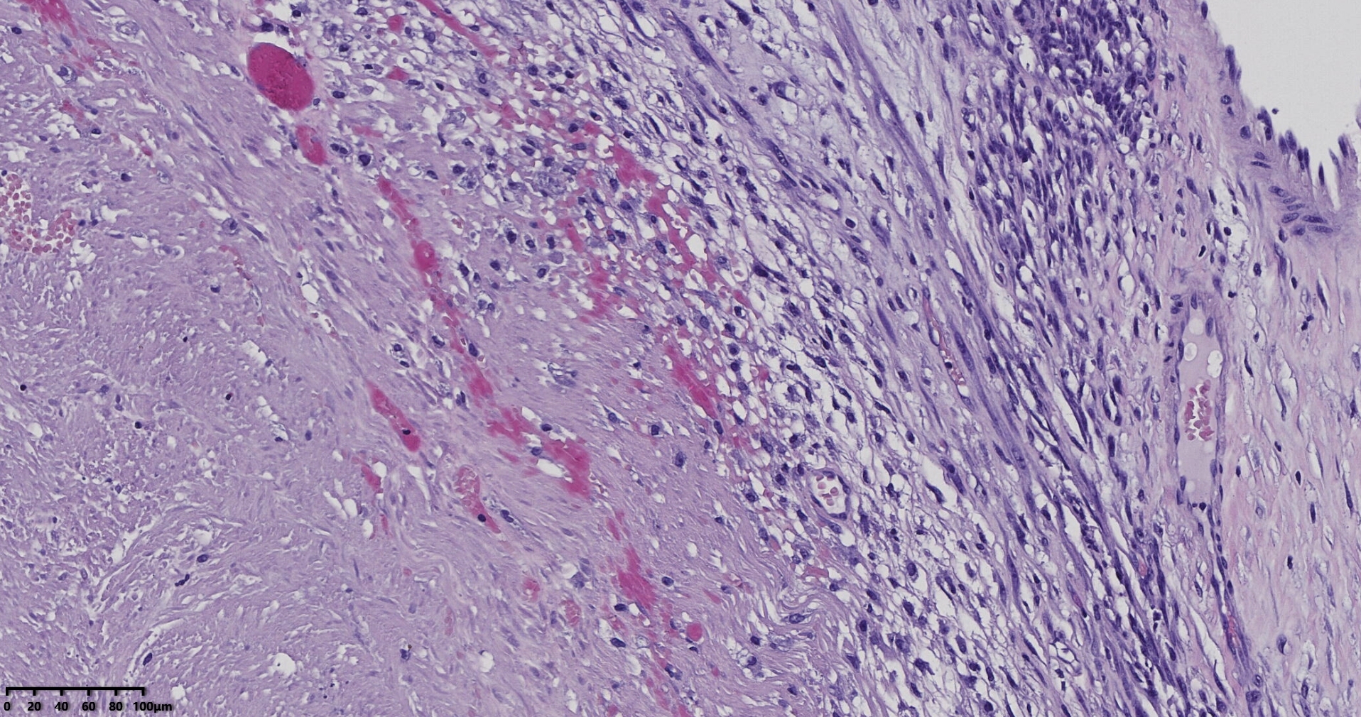 子宫多发性平滑肌瘤伴肉瘤