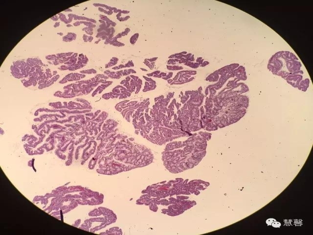 结、直肠管绒毛状腺瘤-高级别病变取材、诊断及报告相关问题（悄悄分享、掌心及孔祥田(Max)*Roswell*NM老师讲解）