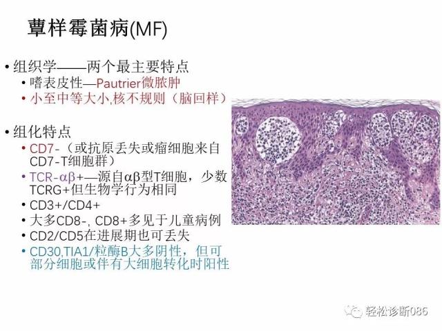 皮肤T细胞淋巴瘤
