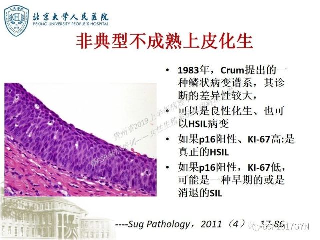 中华病理学会基层培训遵义站讲座（三）——宫颈鳞状上皮病变的病理诊断与鉴别诊断